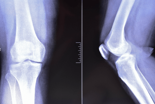 Gonartrosi: Cos’è, Sintomi e Come Curare il Dolore al Ginocchio - Fisioterapia Fani