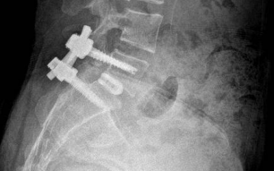 Spondilolistesi L5-S1: dalla radiografia alla riabilitazione dopo l’intervento